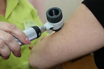 В Центральной городской клинической больнице пройдет акция по профилактике меланомы